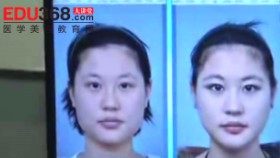 韩国脸型整形手术