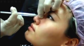 某某视频微晶瓷隆鼻过程是怎么样的？
