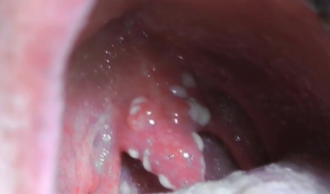 口腔念珠菌感染（鹅口疮）治疗前及治疗后18小时