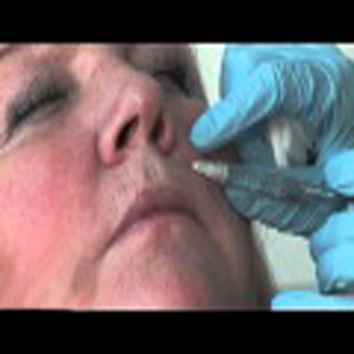 玻尿酸填充治疗鼻唇沟
