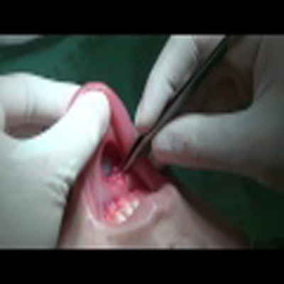 外科整容手术：下颚部填充